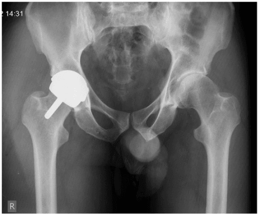 AP pelvis radiograph showing a right hip resurfacing arthroplasty with the native left hip.