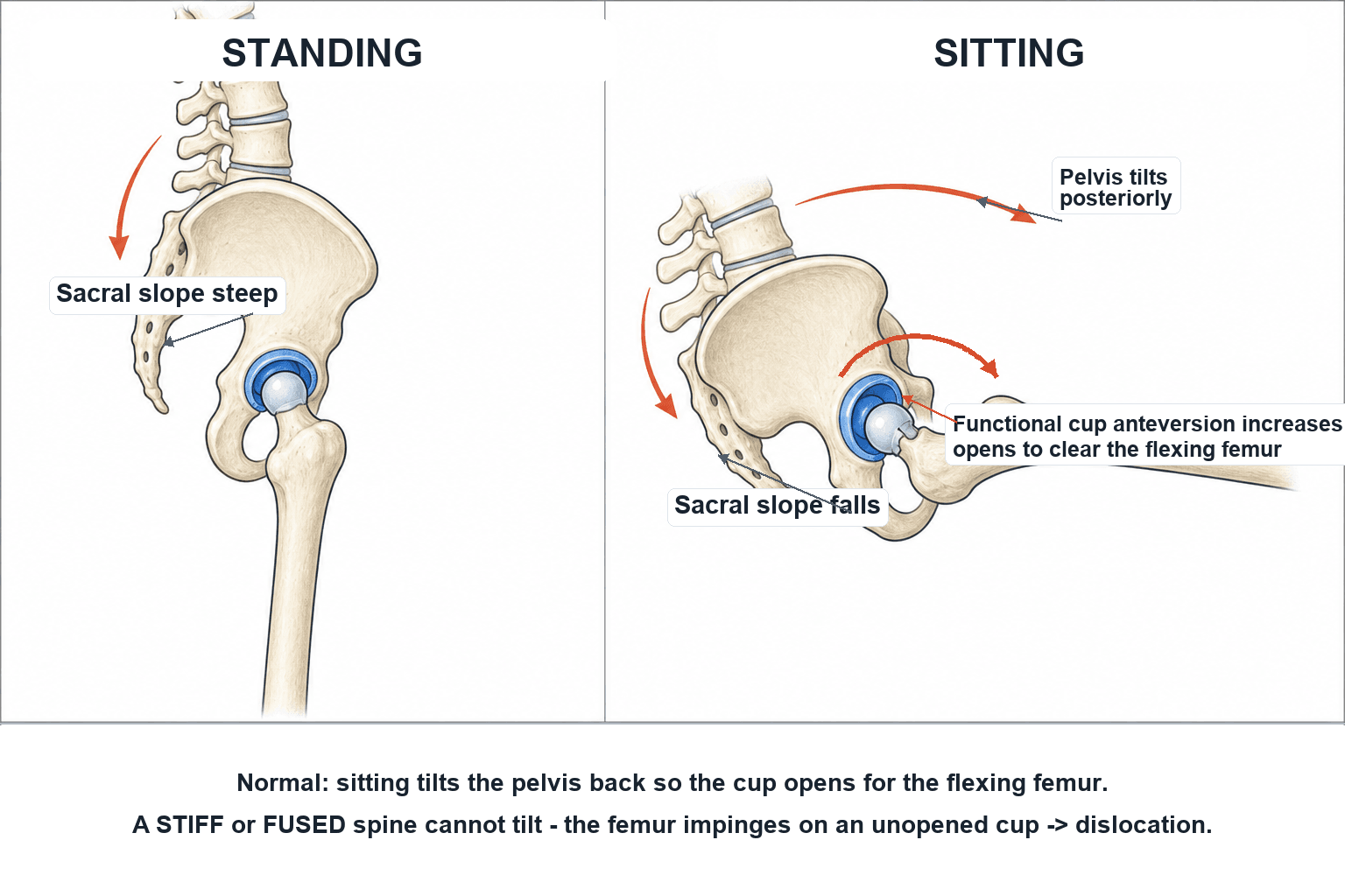 Two-panel lateral schematic comparing standing and sitting spinopelvic posture, showing posterior pelvic tilt and increased functional cup anteversion on sitting.
