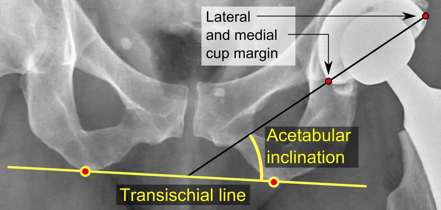 AP pelvis radiograph of a hip prosthesis with the acetabular inclination angle measured between the cup margins and the transischial line — the operative cup-orientation treatment target.