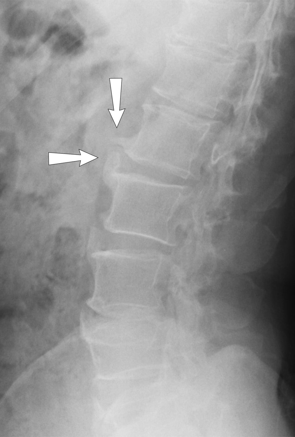 Lateral radiograph of the lumbar spine showing degenerative spondylosis with anterior osteophytes (arrows).