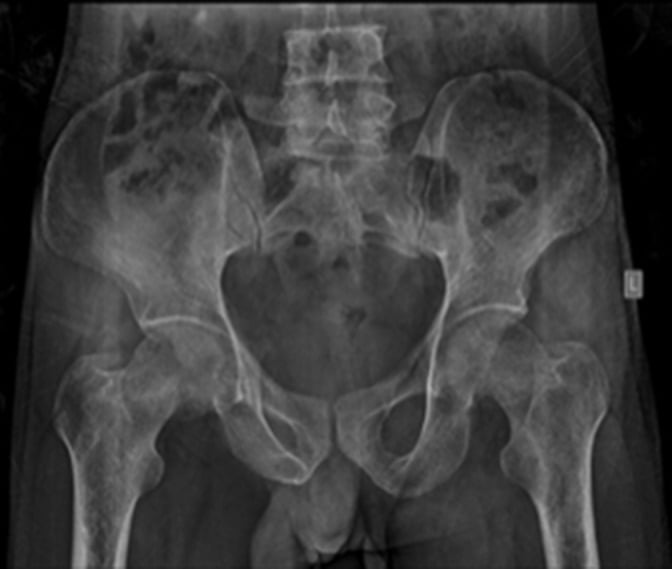 Pelvic radiograph showing diffuse osteoporosis in an HIV-positive patient