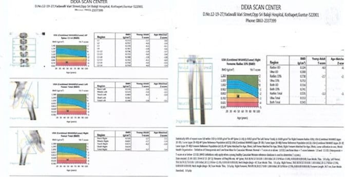 DXA report demonstrating diffuse osteoporosis in an HIV-positive patient