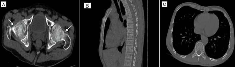 Pelvic and spine CT showing bilateral femoral-neck stress fractures and osteoporosis in HIV