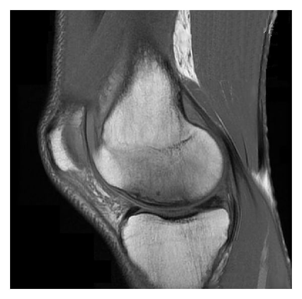 Knee MRI showing severe osteonecrosis in an HIV-positive patient