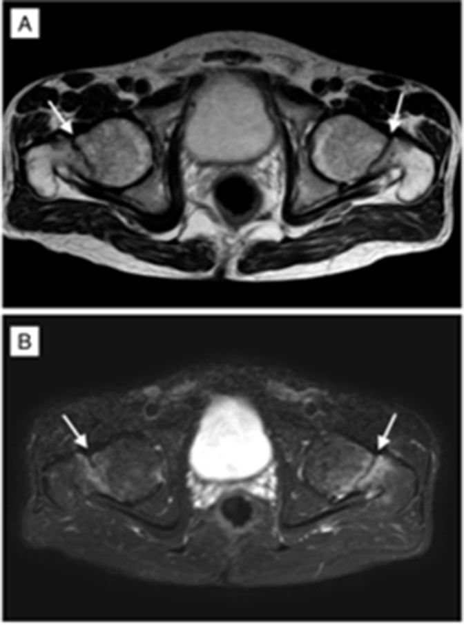 Axial MRI showing bilateral femoral-neck stress fractures and oedema in HIV