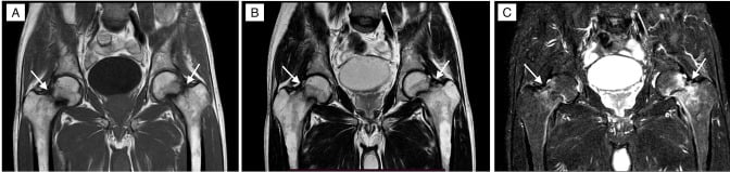 Coronal MRI showing bilateral femoral-neck stress fractures in HIV