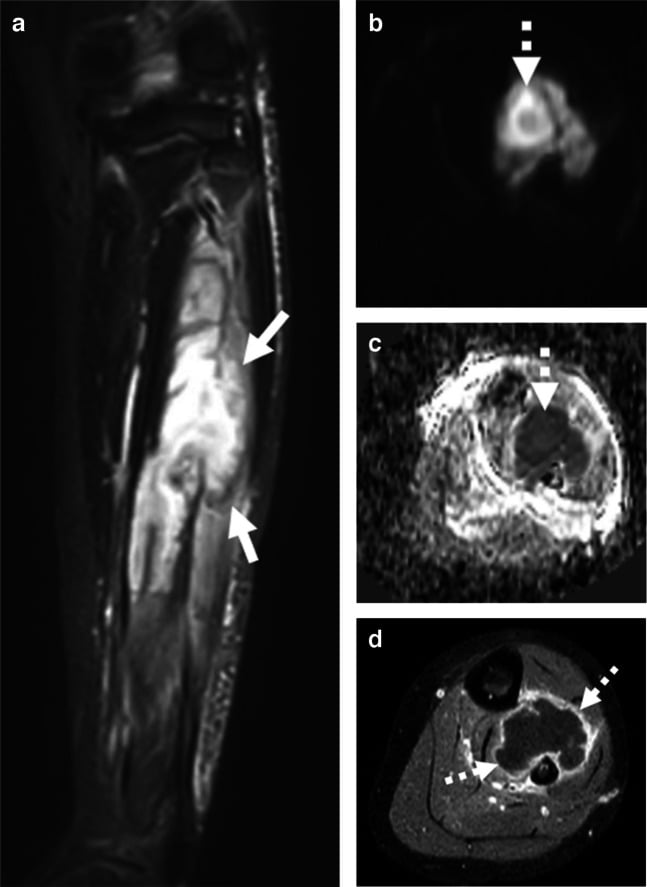 MRI showing pyomyositis with intramuscular abscess and diffusion restriction