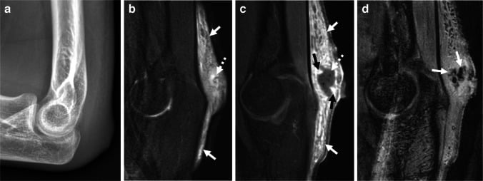 Radiograph and MRI showing septic olecranon bursitis
