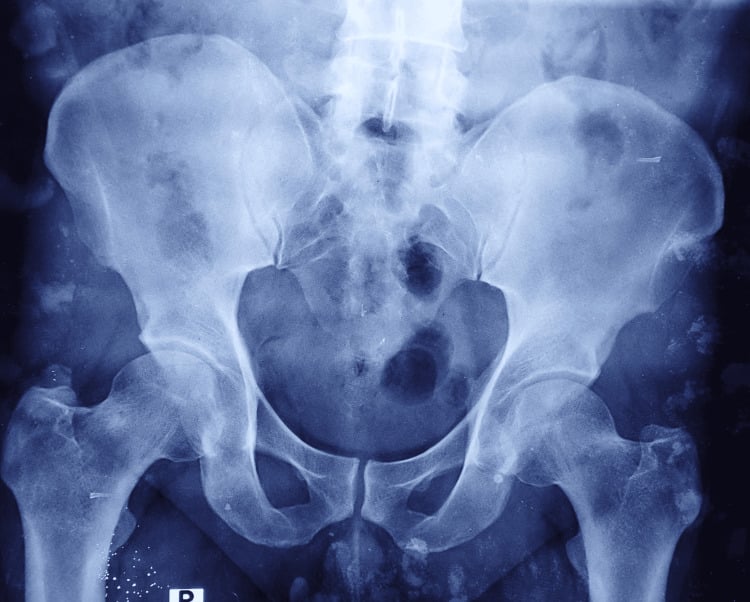 Pelvic radiograph without overt sacroiliac destruction despite MRI-proven tuberculosis