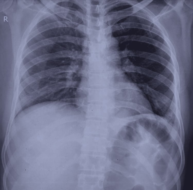Chest radiograph without active pulmonary tuberculosis in multifocal skeletal TB