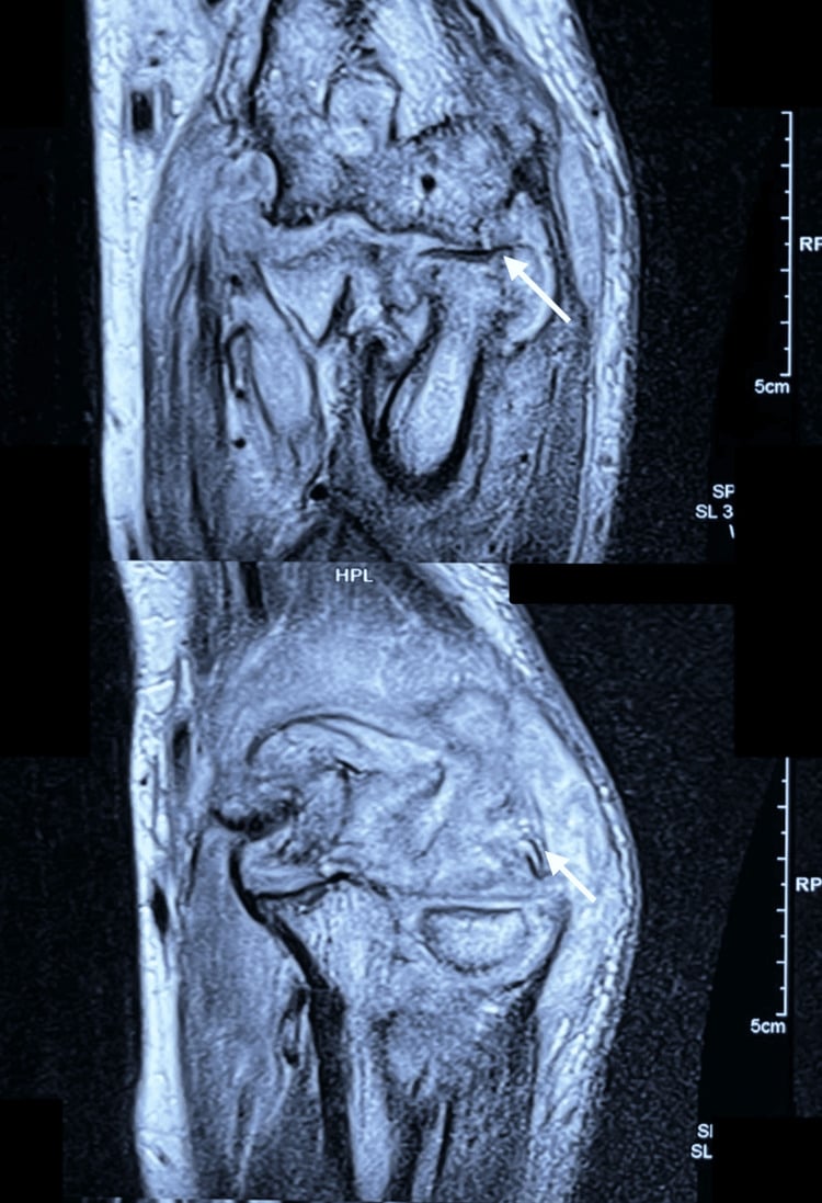 Elbow MRI showing erosive tuberculous arthritis and synovial disease
