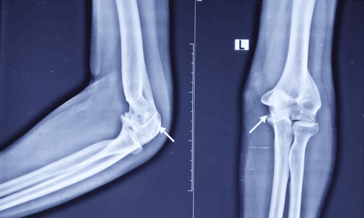 Elbow radiographs showing erosive tuberculous arthritis