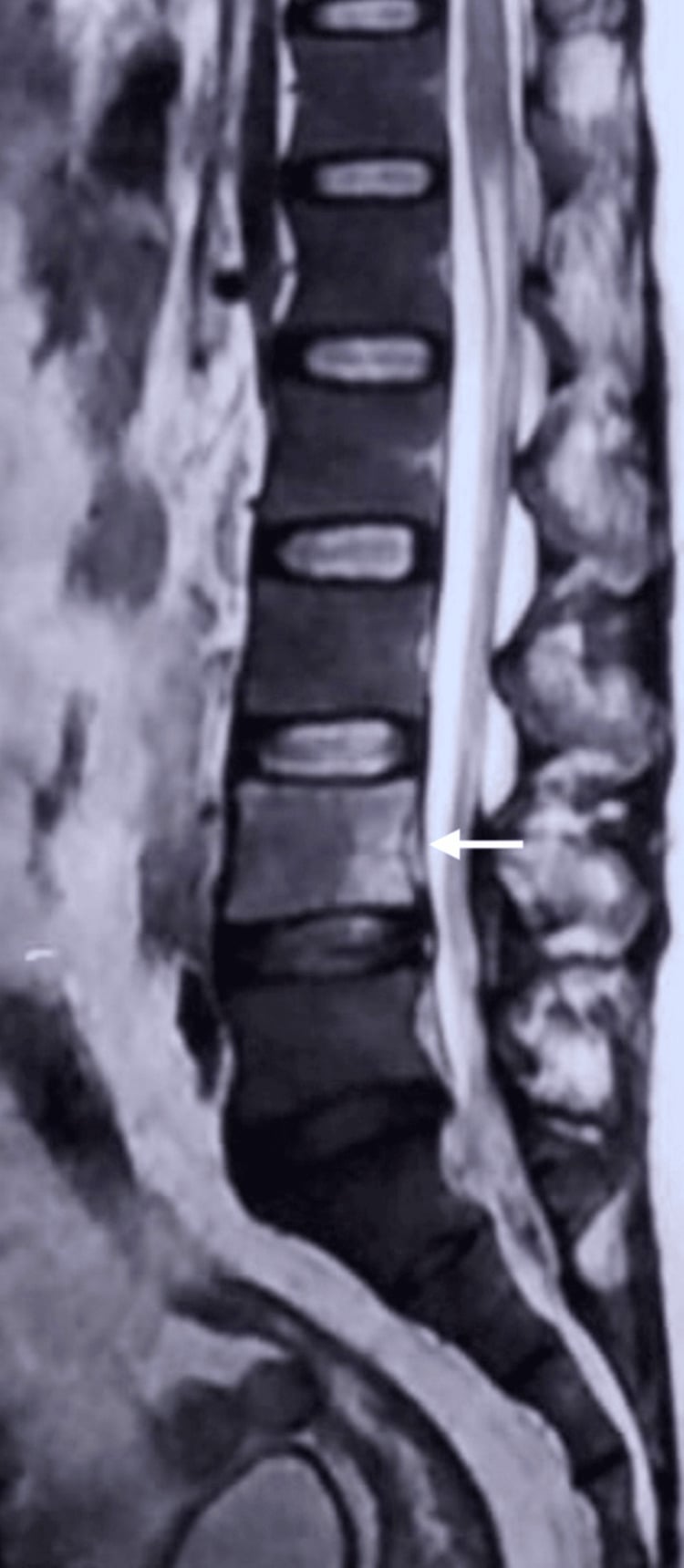 Sagittal lumbar MRI showing destructive spinal tuberculosis at L4