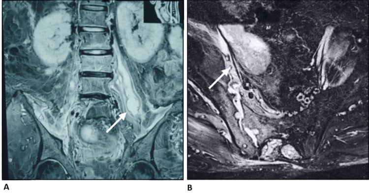 MRI showing tuberculous sacroiliitis with psoas abscess