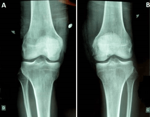 AP radiographs of both knees in a patient with a Hoffa fracture