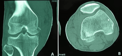 CT of the knee (coronal and axial reformats) demonstrating a Hoffa fracture