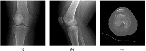 AP/lateral radiographs and axial CT showing a free Hoffa fragment and osteochondral defect