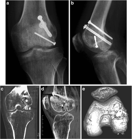 Radiographs and CT showing malunion of the lateral femoral condyle