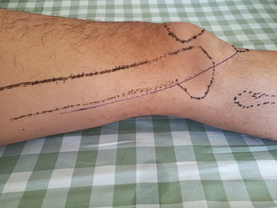 Schematic of the operative incision for lateral femoral condyle fixation
