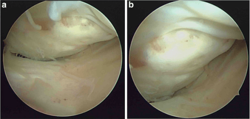 Arthroscopic view of comminuted Hoffa fracture with depressed articular cartilage