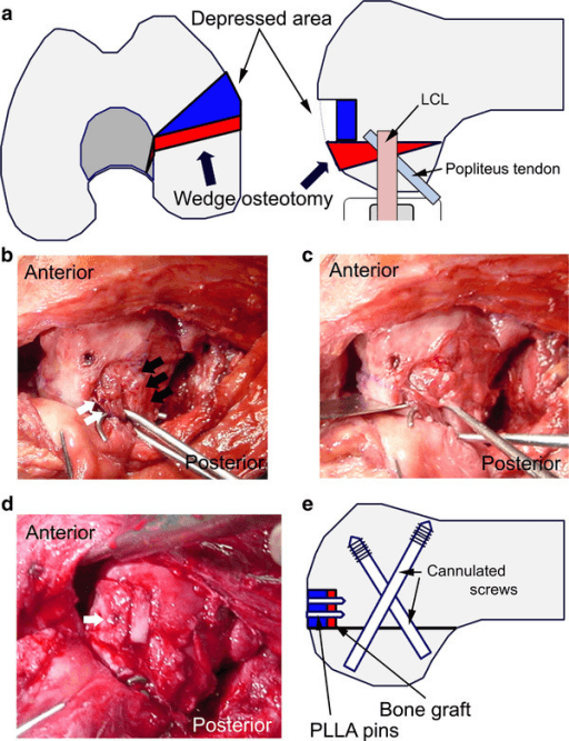 Plan and operative photograph of closed-wedge osteotomy and elevation of a depressed lateral condyle fragment