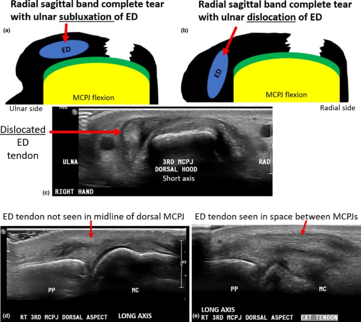 Diagrams and dynamic ultrasound of complete radial sagittal-band tears showing ulnar subluxation or dislocation of the extensor tendon during MCP flexion.