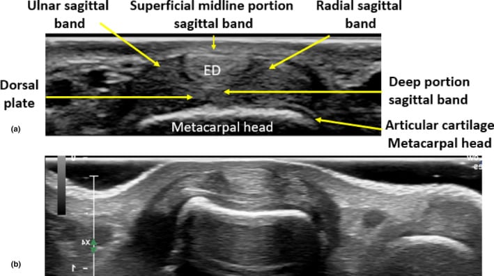 Short-axis ultrasound of the dorsal third MCP joint, with and without labels, identifying the extensor digitorum tendon, superficial and deep sagittal-band fibres, dorsal plate, articular cartilage and metacarpal head.