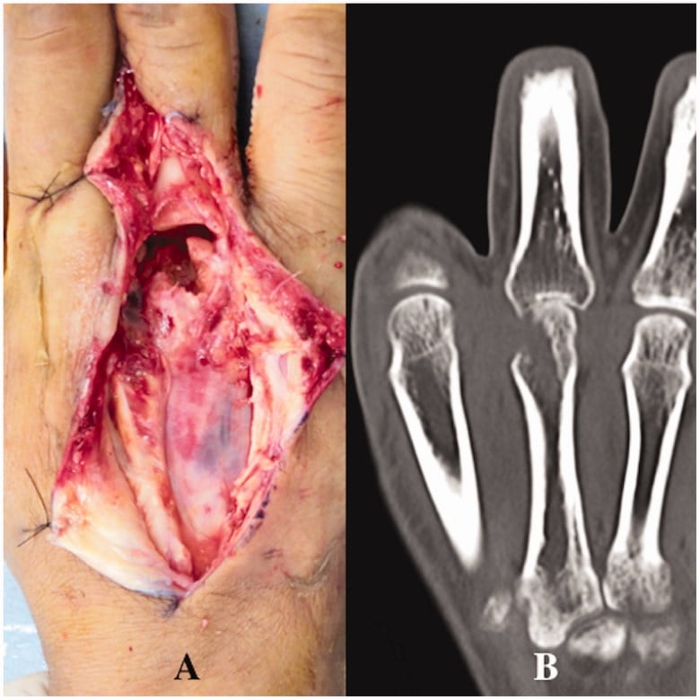 Intraoperative exposure of bite-related extensor and metacarpal-head injury paired with CT showing articular bone loss and joint-space narrowing.