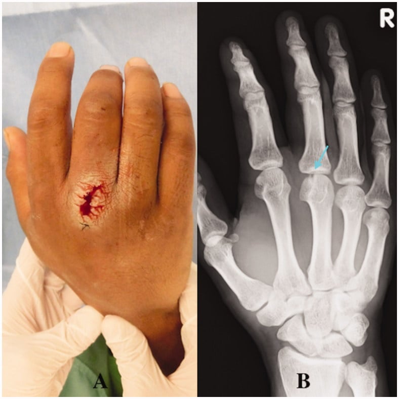 Purulent dorsal wound over the third MCP joint paired with an oblique hand radiograph showing the tooth-sign defect at the metacarpal head.