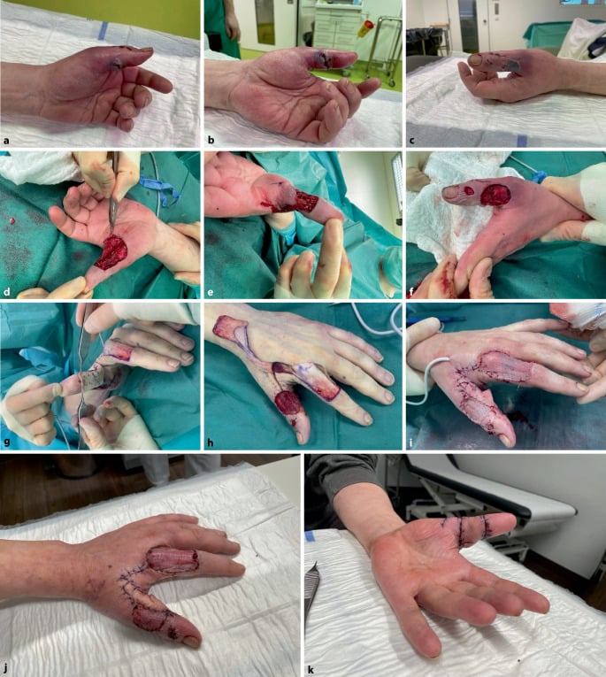 Serial clinical photographs of a severe human-bite infection of the thumb before and after repeated debridement and irrigation.