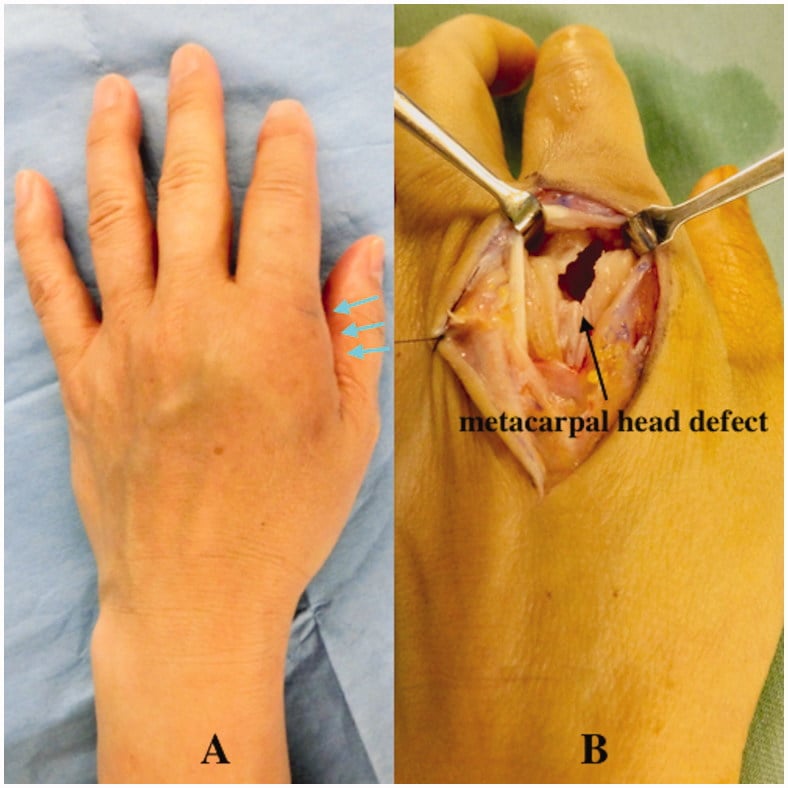 Dorsal MCP swelling and erythema with operative exposure demonstrating a partial metacarpal-head defect caused by bite-associated infection.