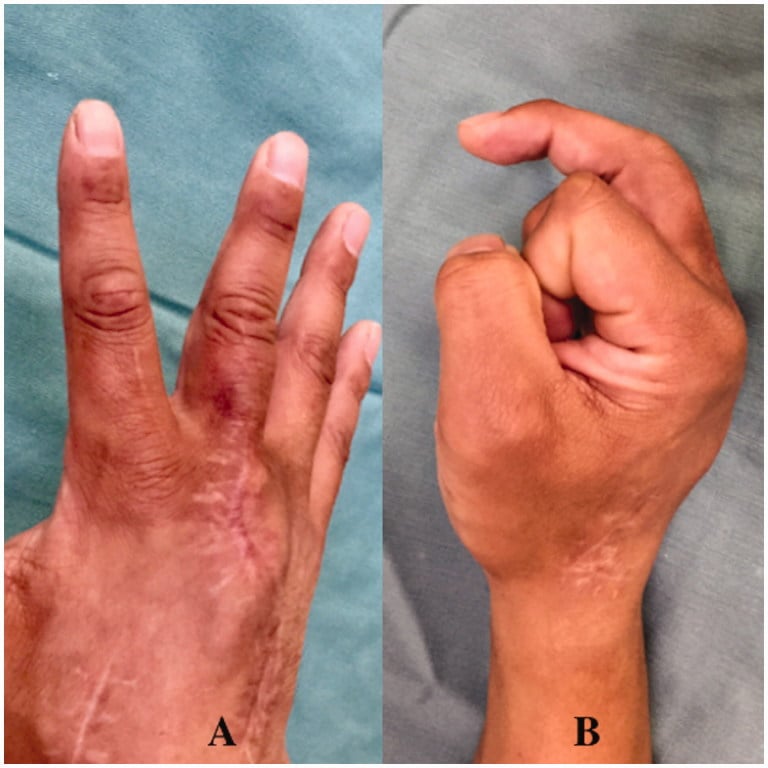 Clinical photographs showing the final MCP motion arc after osteochondral reconstruction for bite-related metacarpal-head loss.