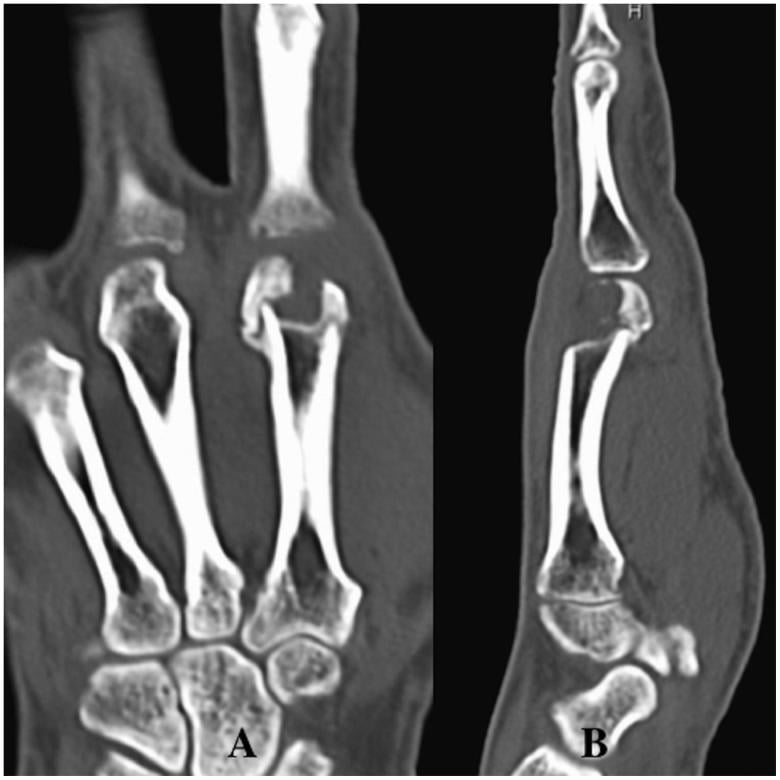 Coronal and sagittal CT images showing an articular defect of the metacarpal head after an infected clenched-fist injury.