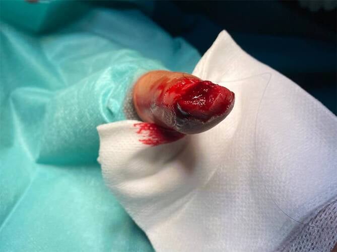 Clinical photograph of a direct human occlusal bite to the index fingertip with nail avulsion.