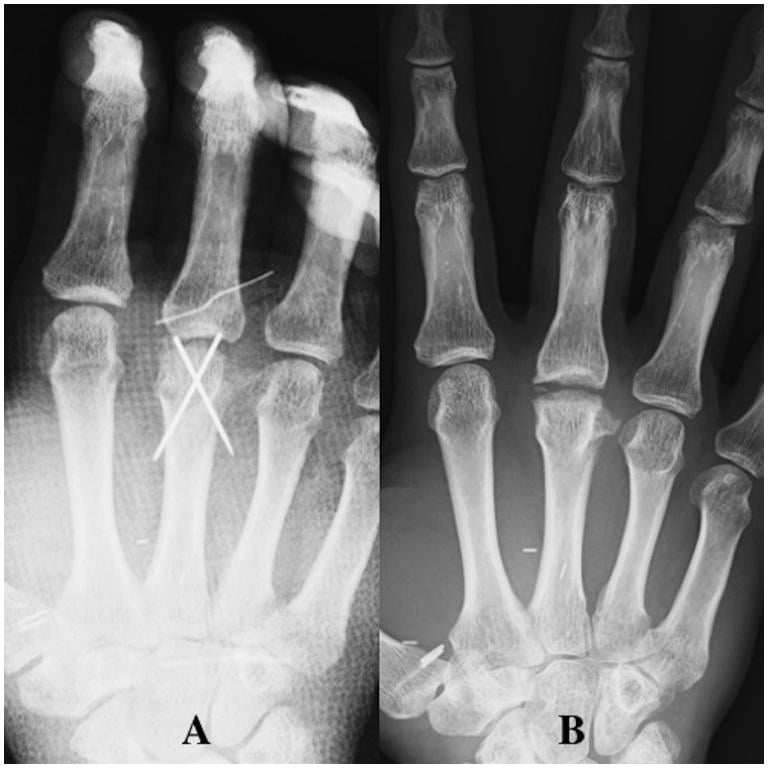 K-wire fixation of an osteochondral reconstruction of the metacarpal head and follow-up radiograph showing preserved MCP joint space.