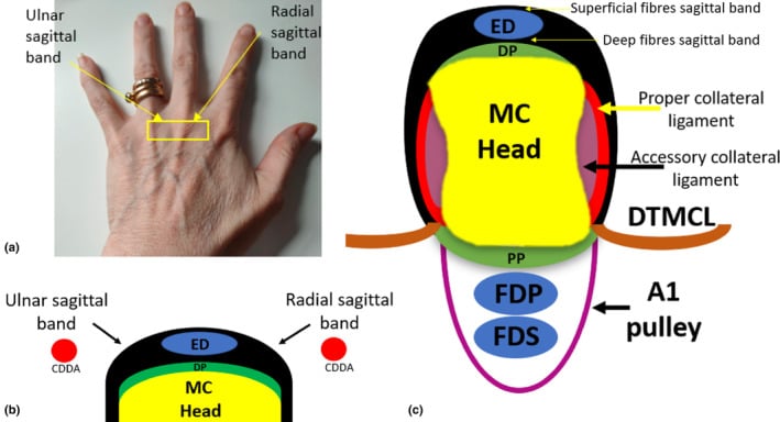 Surface landmark and transverse schematic of the dorsal MCP extensor hood showing the extensor tendon centred by radial and ulnar sagittal bands over the metacarpal head.