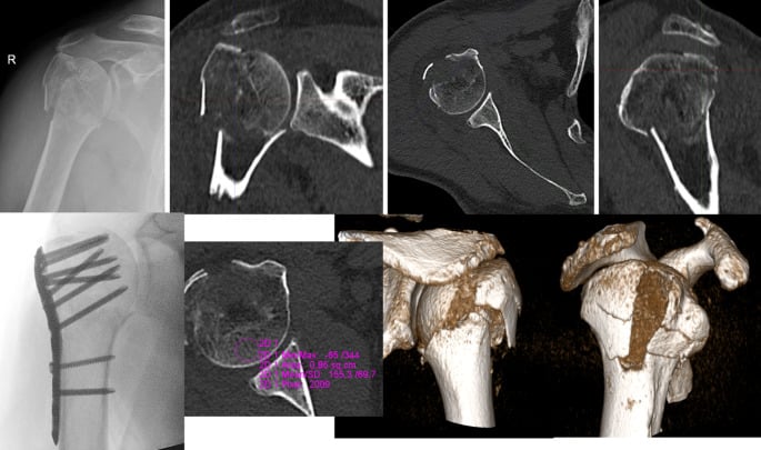 Radiograph, CT slices, three-dimensional reconstructions and postoperative plate fixation of a four-part proximal humerus fracture