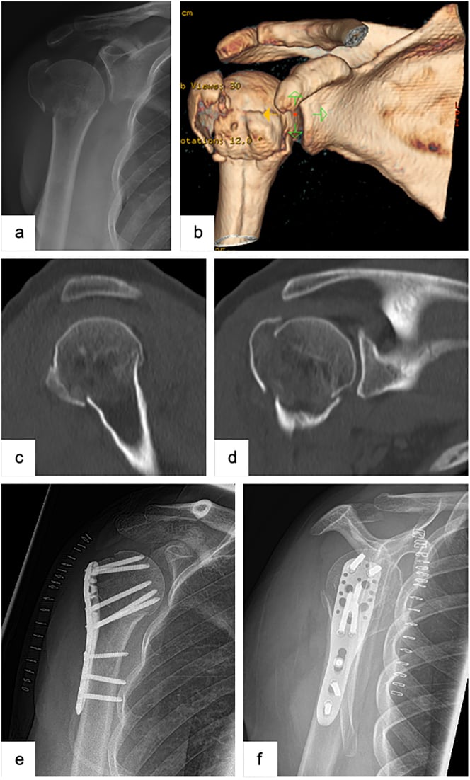 Radiograph and CT of a valgus-impacted dislocated three-part proximal humerus fracture with postoperative fixation