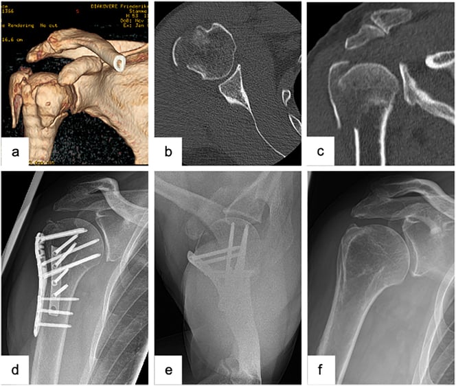Three-dimensional and multiplanar CT, postoperative plate fixation and a radiograph without the implant, of a valgus four-part fracture