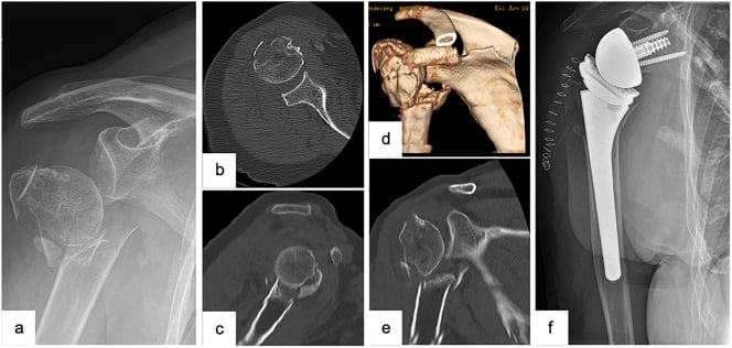 Radiograph and CT of a varus-displaced four-part fracture with postoperative reverse arthroplasty