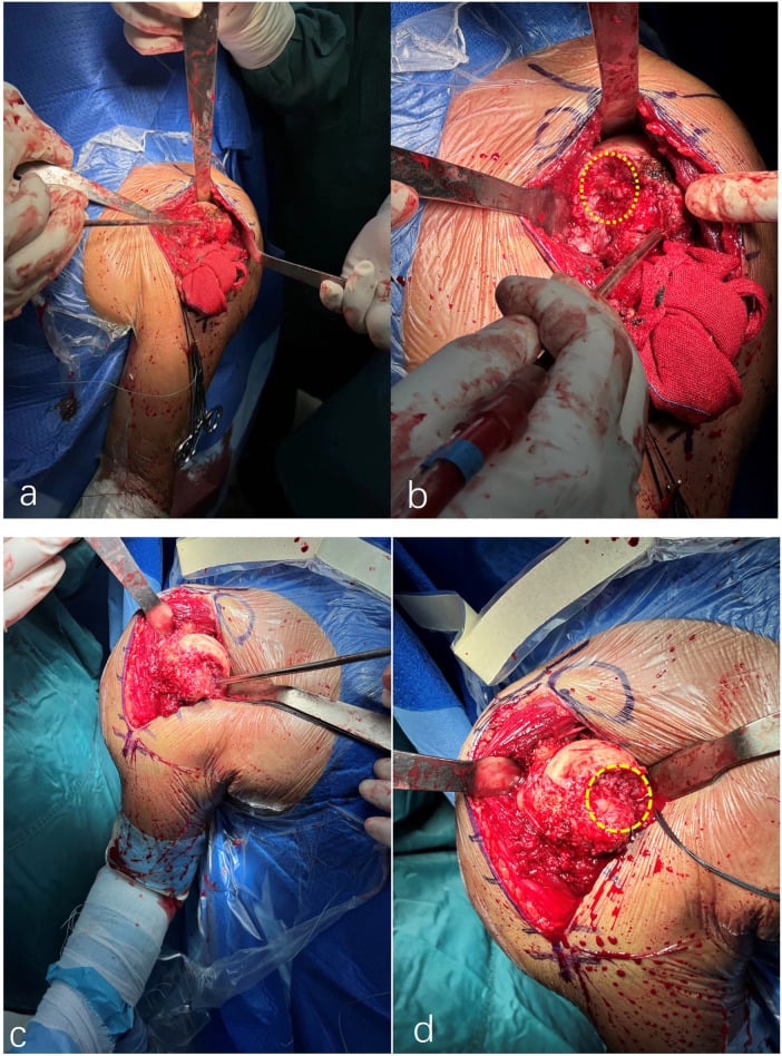 Operative views showing a humeral-head articular defect greater than half the surface