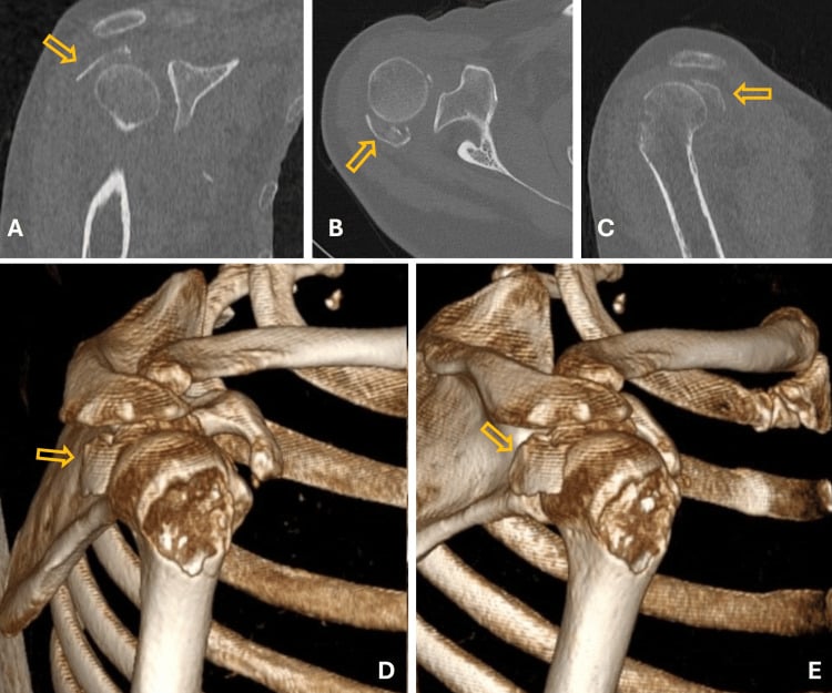 Multiplanar and three-dimensional CT showing a posterosuperiorly displaced greater-tuberosity fragment