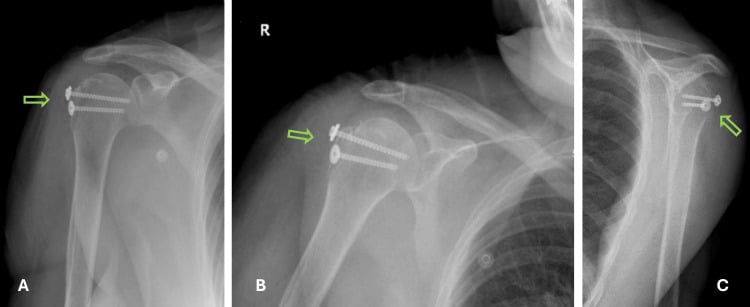 Postoperative radiographs showing cannulated-screw fixation of the greater tuberosity