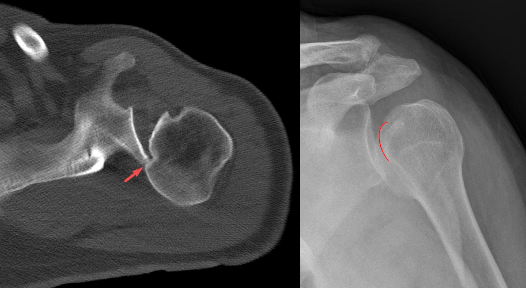 Axial CT and AP radiograph of a posterior shoulder dislocation showing a reverse Hill-Sachs impression lesion of the anteromedial humeral head