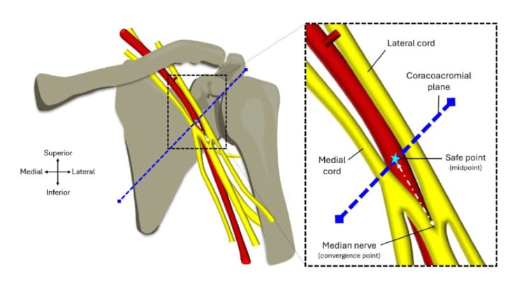 Anatomical line diagram of median and radial nerve surgical safety zones