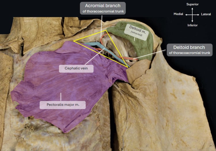 Anatomical dissection of the deltopectoral groove and cephalic vein