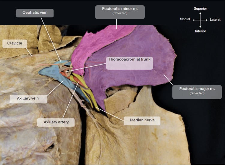 Anatomical dissection of the infraclavicular fossa and brachial plexus