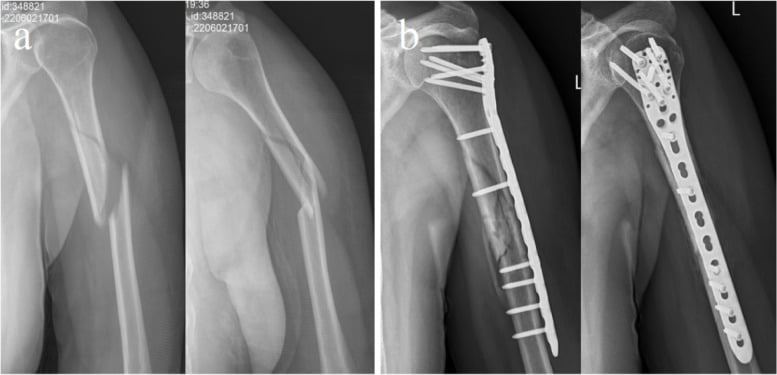 Preoperative and postoperative radiographs of mid-proximal humeral shaft fracture locking plate fixation