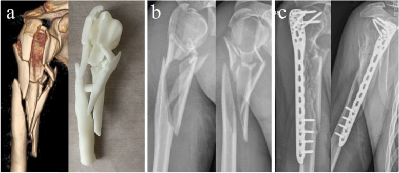 Preoperative 3D CT model and postoperative radiographs of complex humeral shaft fracture MIPO