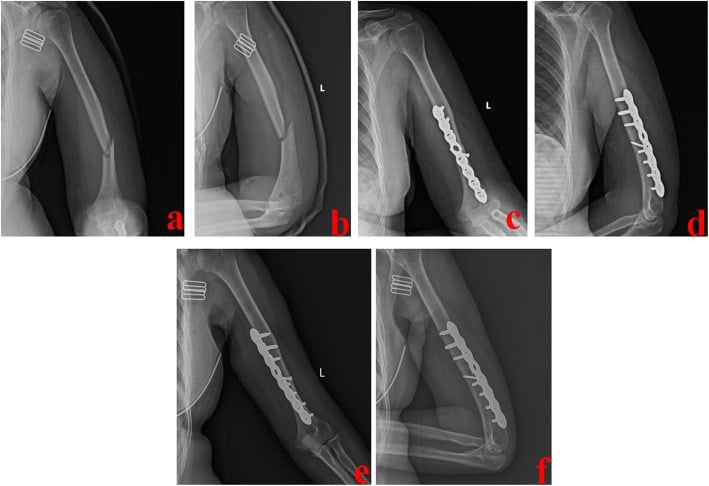 Preoperative and postoperative radiographs of humeral shaft fracture anterior bridge plating